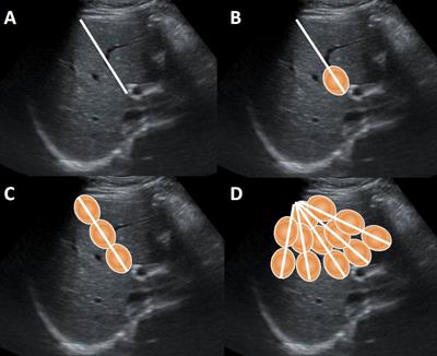 Study of ultrasound-guided percutaneous microwave ablation combined with portal vein embolization for rapid future liver remnant increase of planned hepatectomy